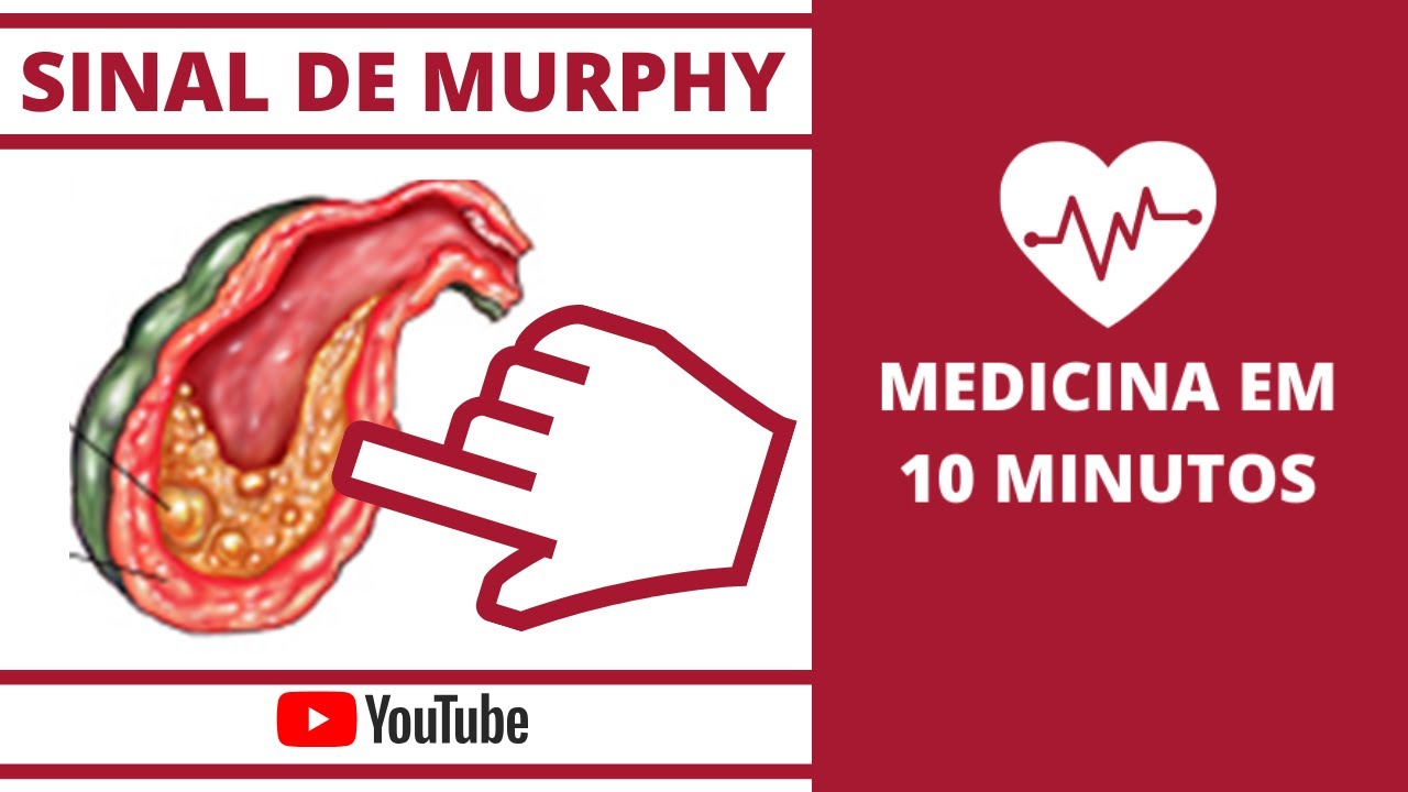 Aprenda a realizar a manobra para pesquisar o Sinal de Murphy !! VESICULA BILIAR INFLAMADA ??