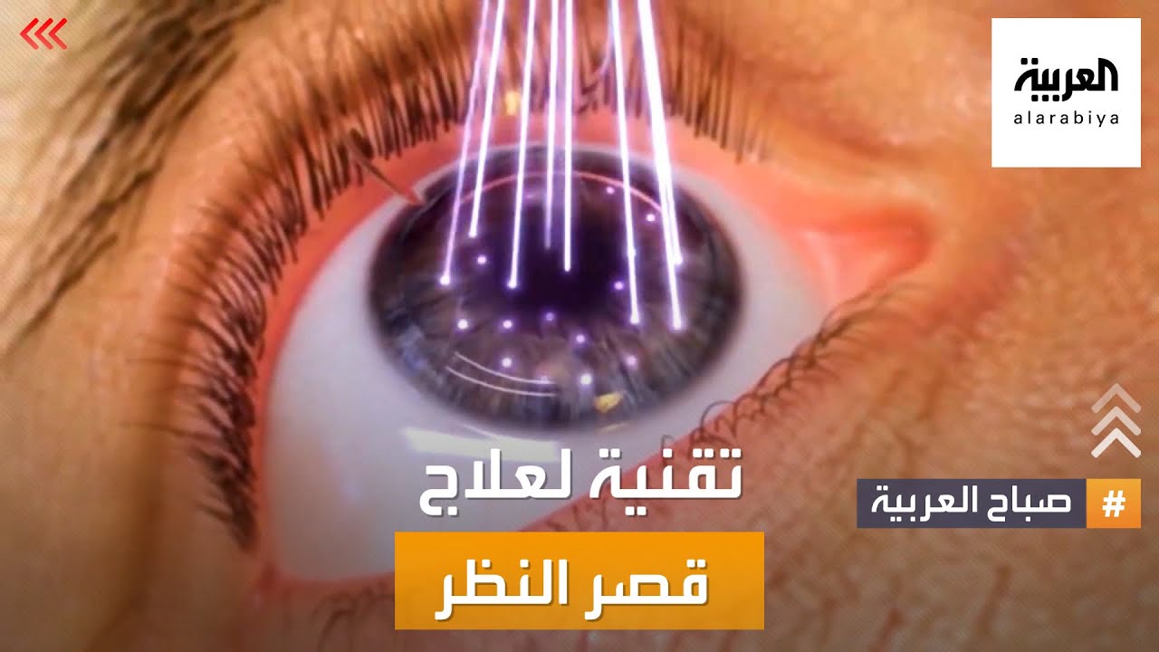 صباح العربية | تقنية جديدة تعيد الأمل لعلاج قصر النظر