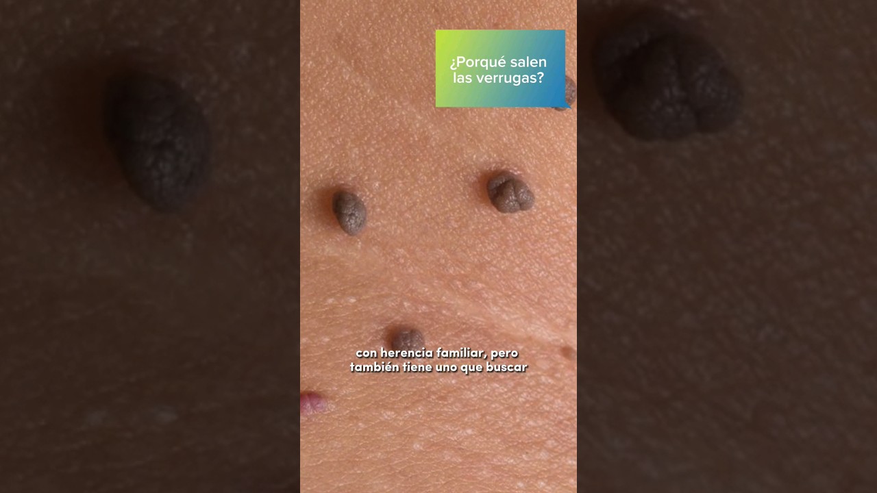 &iquest;Porqu&eacute; salen las verrugas? #cuidadodelapiel #verrugas #onderm #dermatologia #dermatologo #diabetes