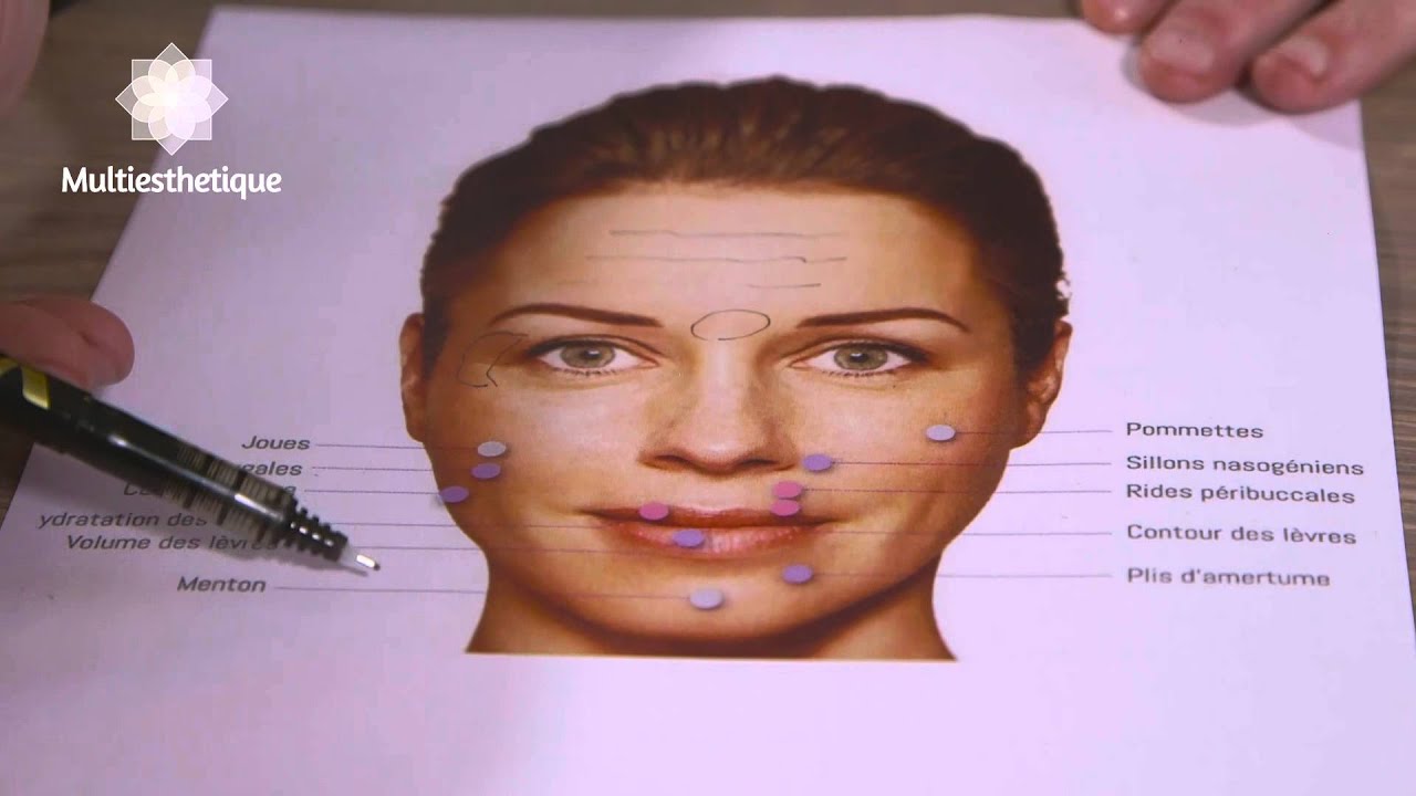 Remodelage du visage par l&rsquo;Acide hyaluronique &ndash; Dr Nicolas Costa