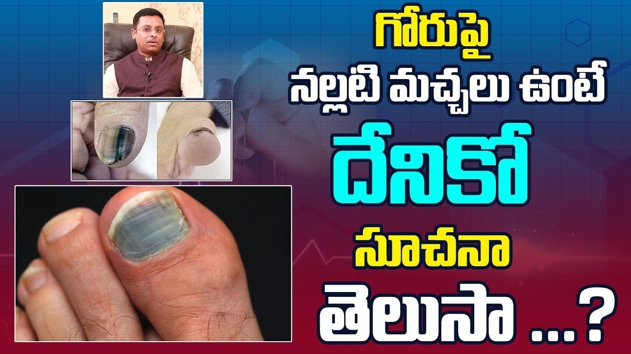 గోరు పై నల్లటి మచ్చలు ఉంటే దేనికో సూచనా  తెలుసా ...?||Black Nails||Myra Jeevan