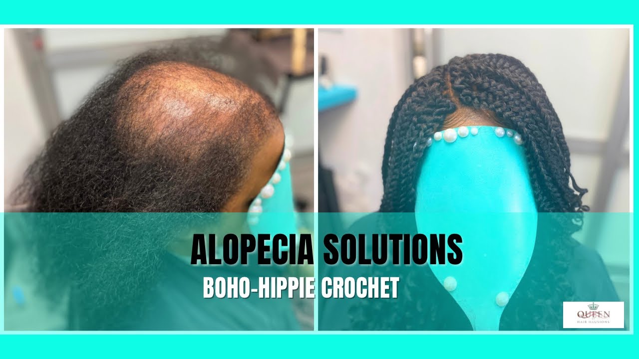 It’s Installation of the Hair Loss Crochet Foundation