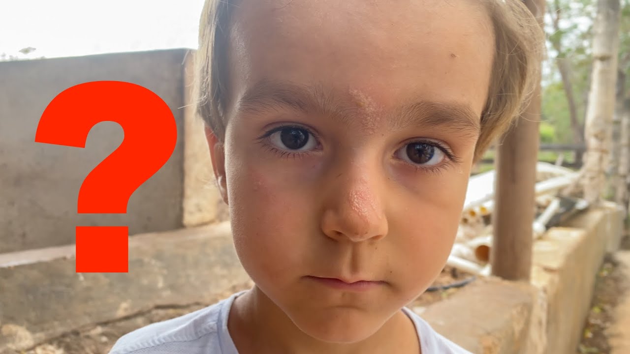 Infection bizarre sur le visage de Timothy