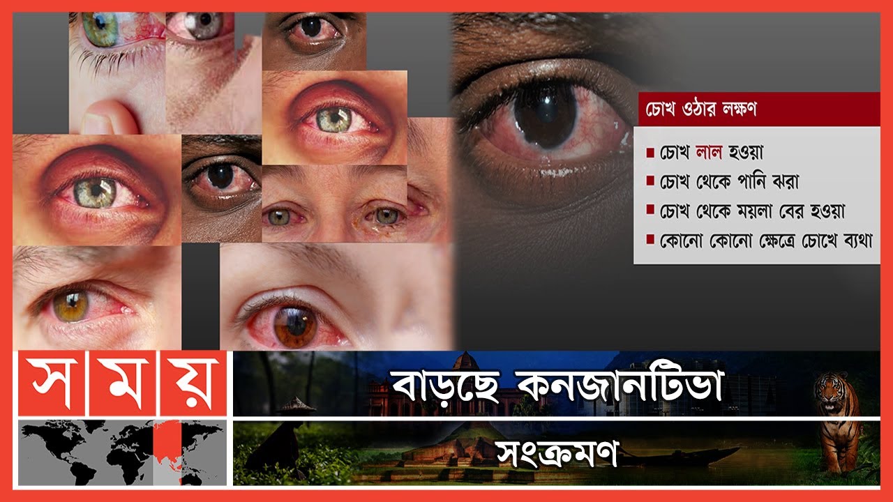 চোখ ওঠায় আইড্রপ ব্যবহার করলে হতে পারে হিতে বিপরীত | Conjunctiva Disease | Conjunctivitis | Somoy TV
