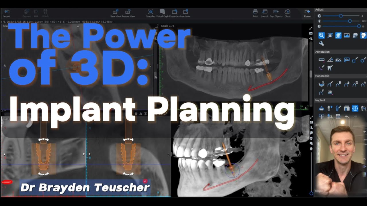 The Power of 3D CBCT Implant Planning