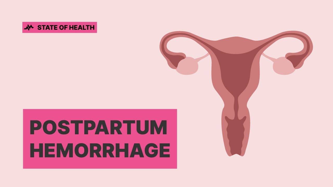 Postpartum hemorrhage: Early detection can save lives
