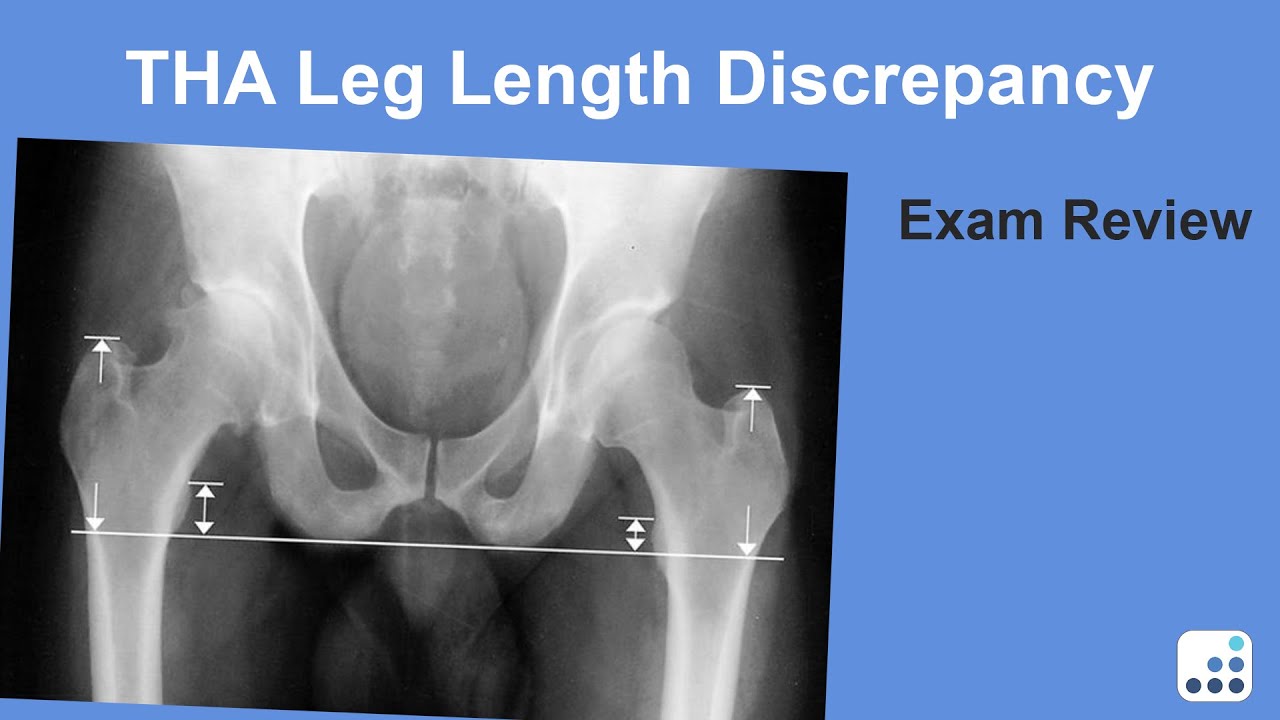 Leg Length Discrepancy - Daniel Berry, MD