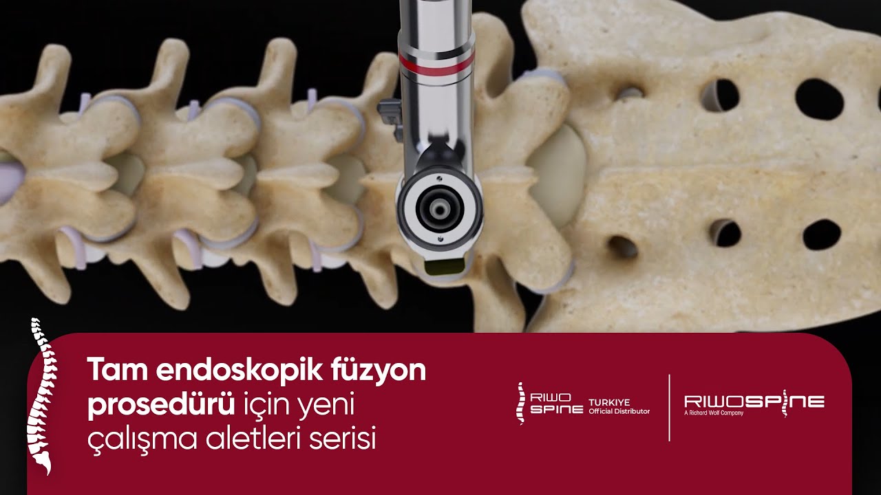 Tam endoskopik füzyon prosedürü için yeni çalışma aletleri serisi | @RIWOspine #omurgasağlığı