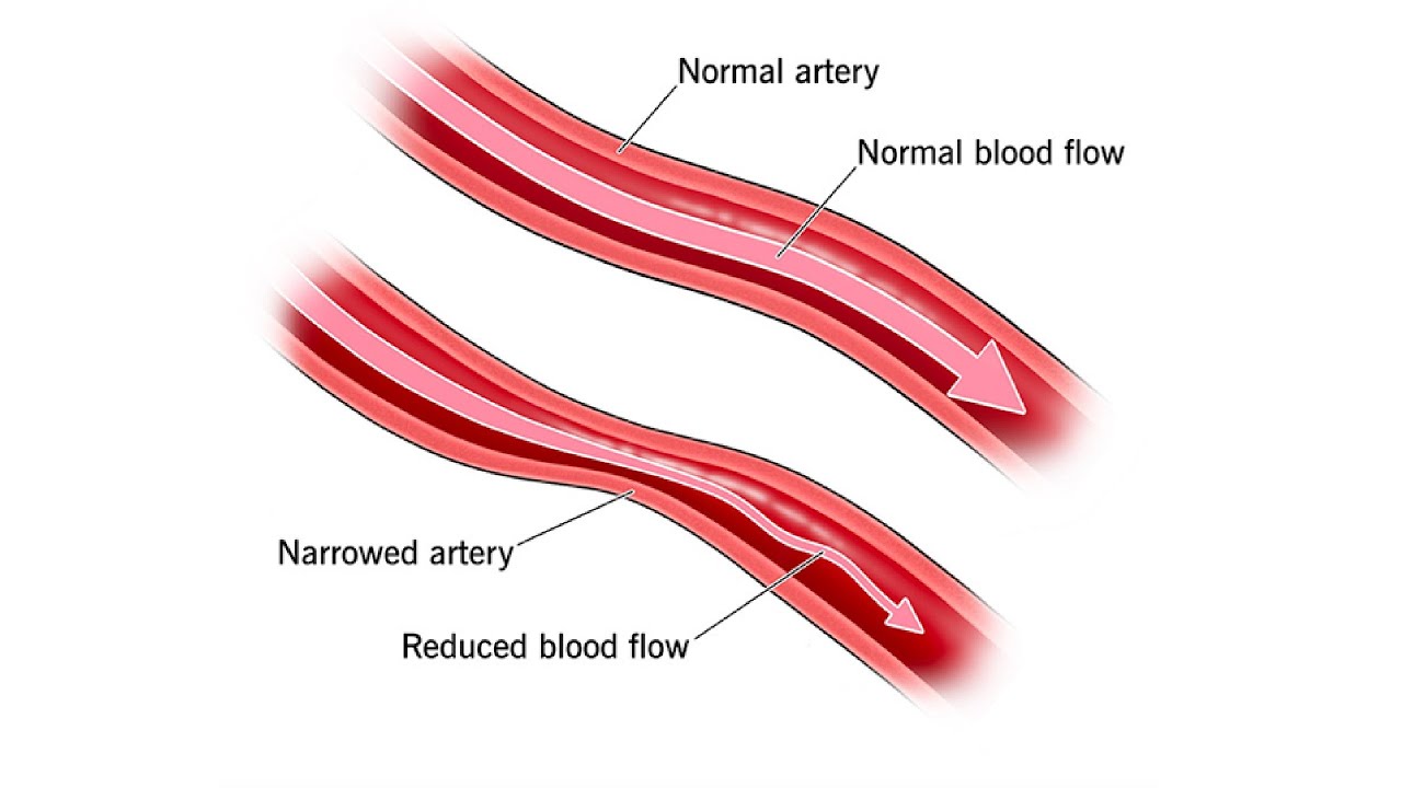 Vasospasms and Myocardial Bridges