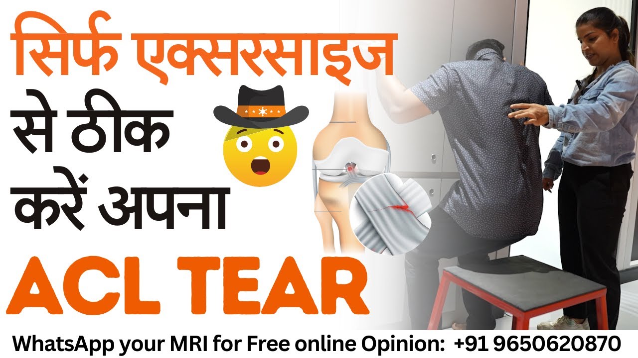 #ACL Tear का इलाज बिना सर्जरी के सिर्फ एक्सरसाइज से ||  ACL Injury heal without surgery
