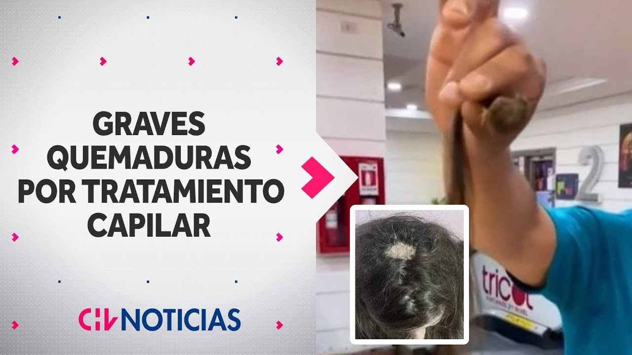 Joven denuncia GRAVES QUEMADURAS tras procedimiento capilar en Quilpué - CHV Noticias