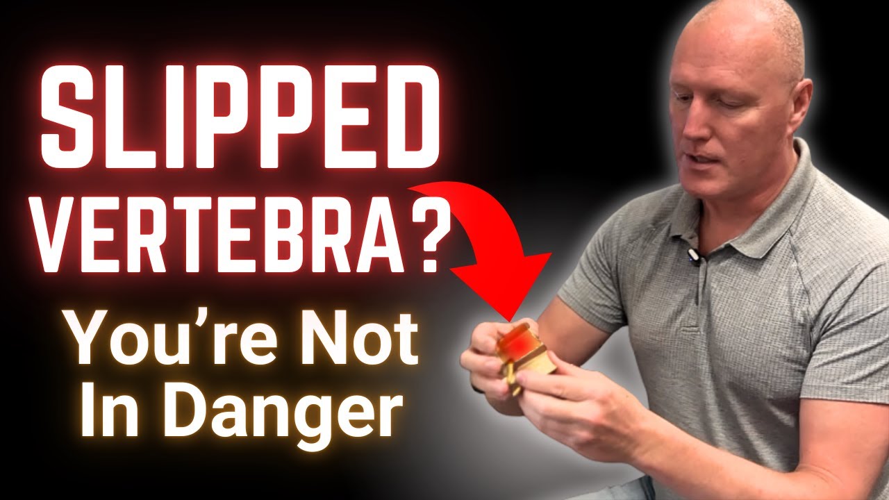 What It Means When a Vertebra Slips (Anterolisthesis, Retrolisthesis, Spondylolisthesis Explained)