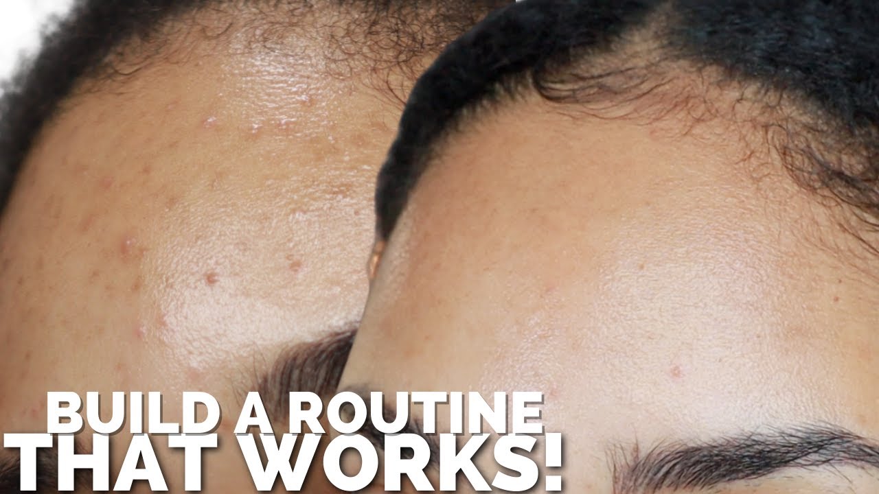 Skincare Routine that works! All the extras, Retinoids, Acne Treatments, Dark Spots