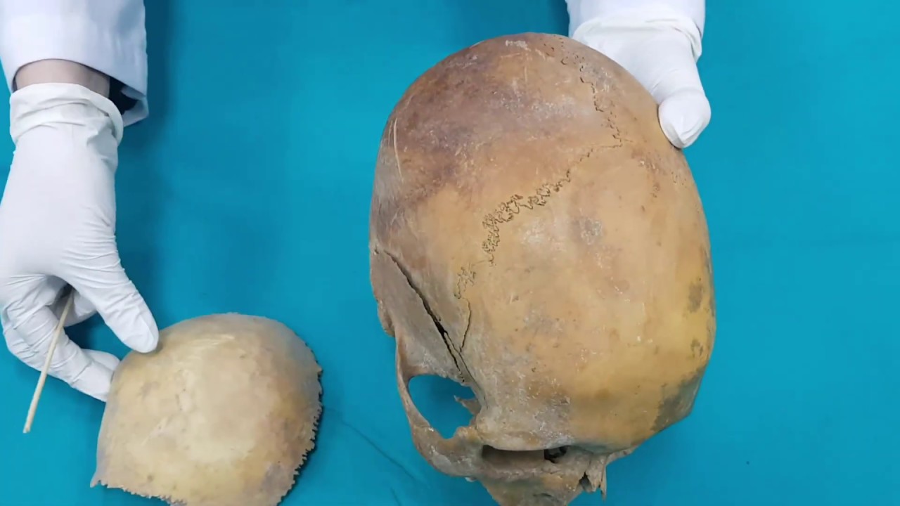 Anatomi Kemikler Ossa Cranii-Neurocranium Kemikleri-Os Parietale Anatomisi (kemikler anatomi)