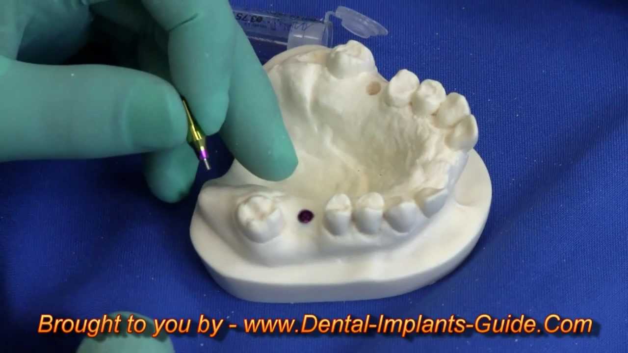 Mis-Implants c1 dental implant placement