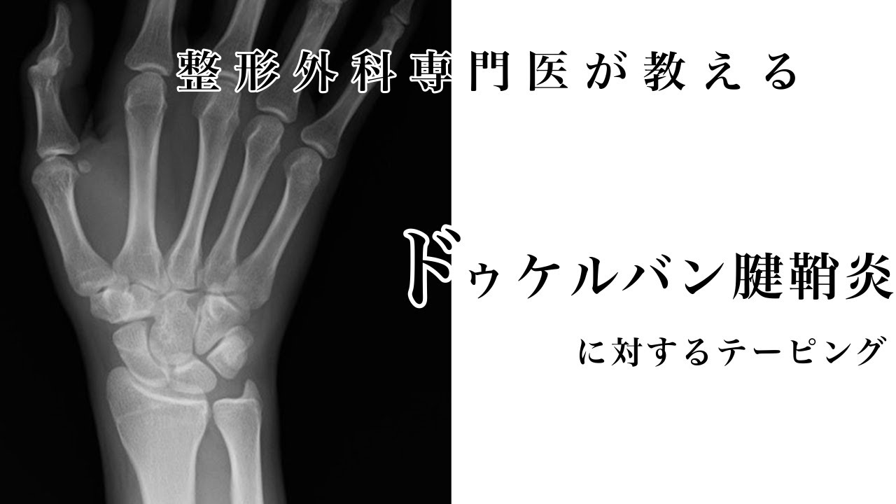 医師が教える！ドゥケルバン腱鞘炎に対するテーピング！【有栖川整形外科】