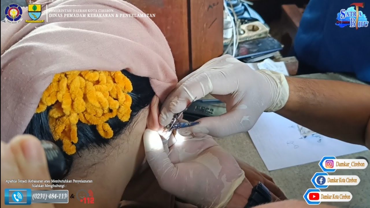 Evakuasi Pelepasan Anting-anting yang Menginfeksi Telinga