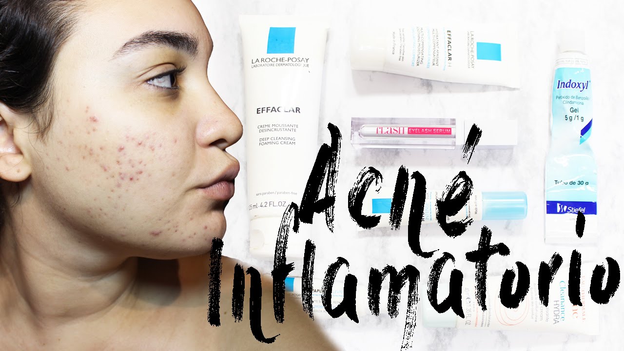 MI RUTINA FACIAL PARA ACNÉ| #VeranoconMaquis