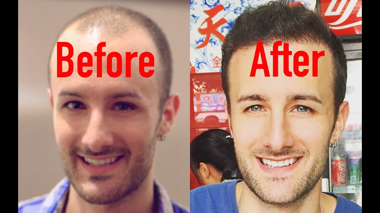 Hair Systems & Wigs vs. Hair Transplants