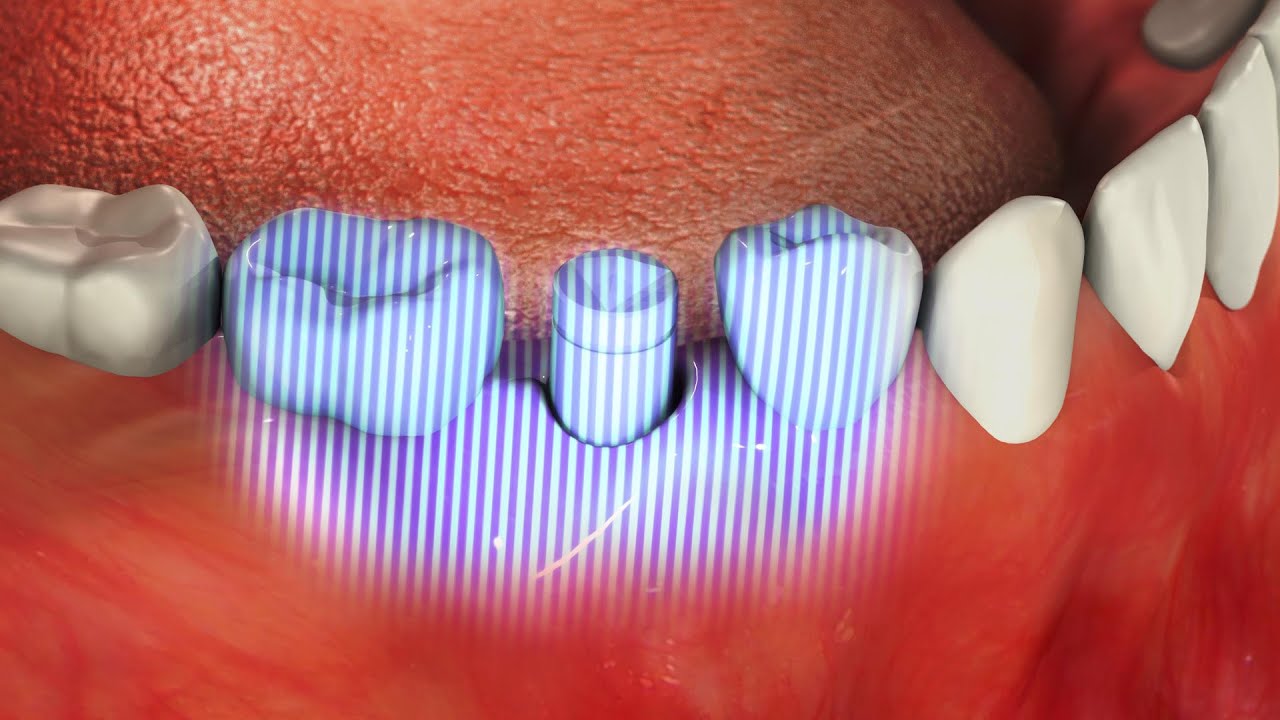 CAD/CAM Abutment with SICvantage max Dental Implant