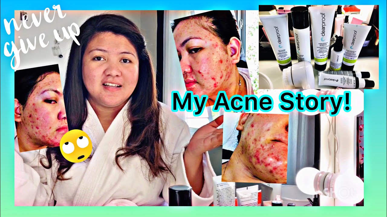 VLOG17: How to get rid of stubborn pimples! | Mary Kay Clearproof Line Skin care routine 💞