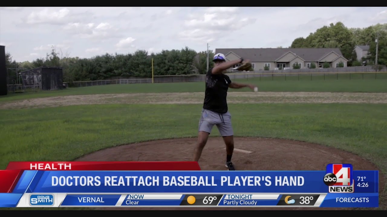 Doctors reattach baseball player's hand