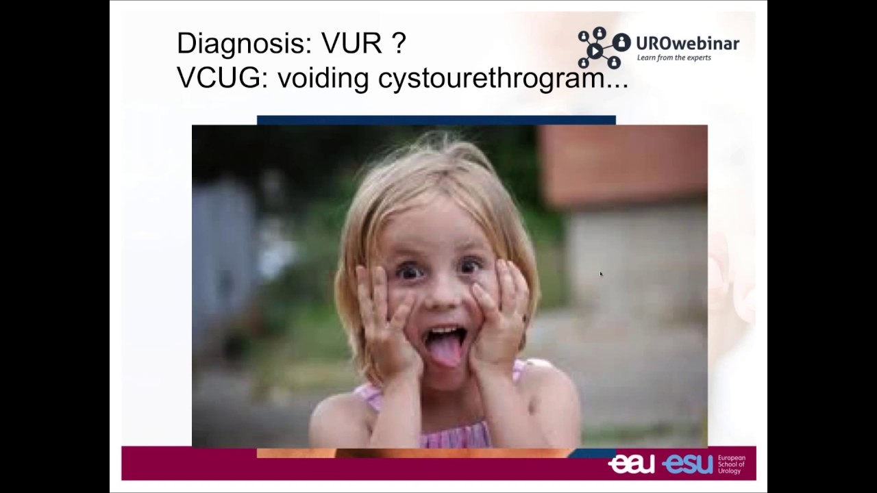 Urowebinar: Vesicoureteral reflux to treat or not to treat