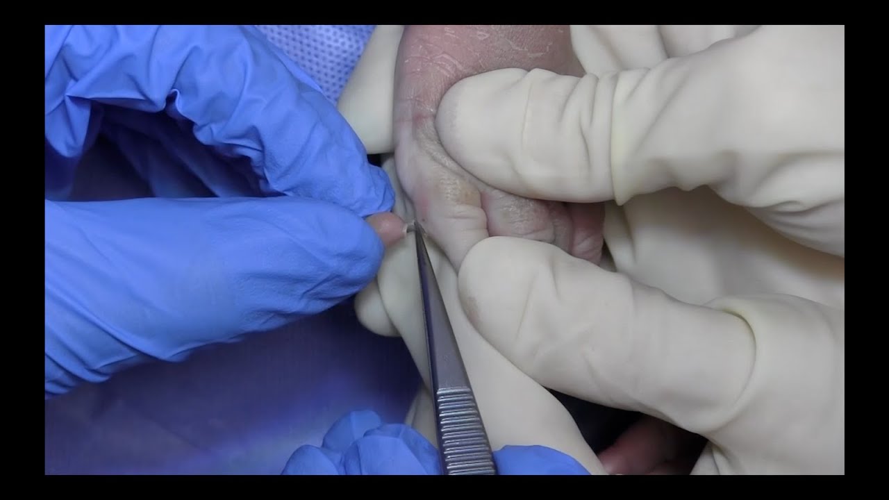 In-Office Postaxial Polydactyly Type B Removal