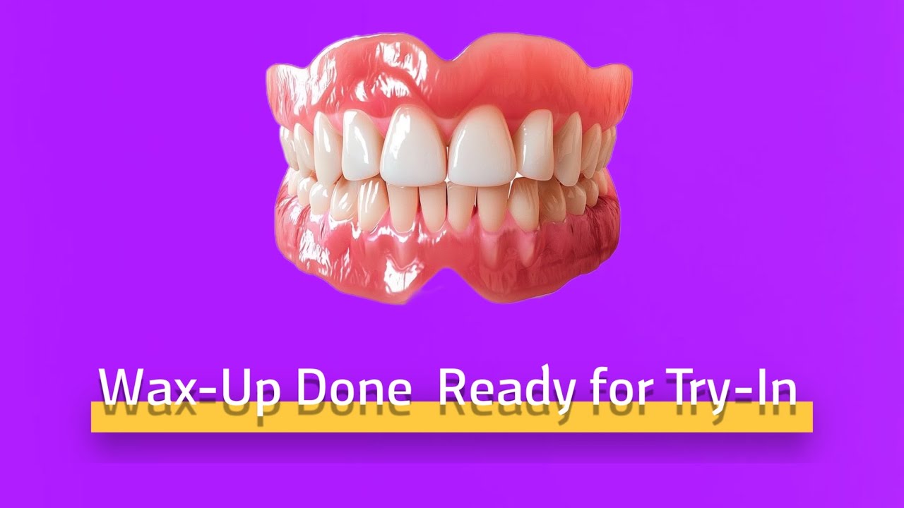 Final Wax-Up Ready for Try-In