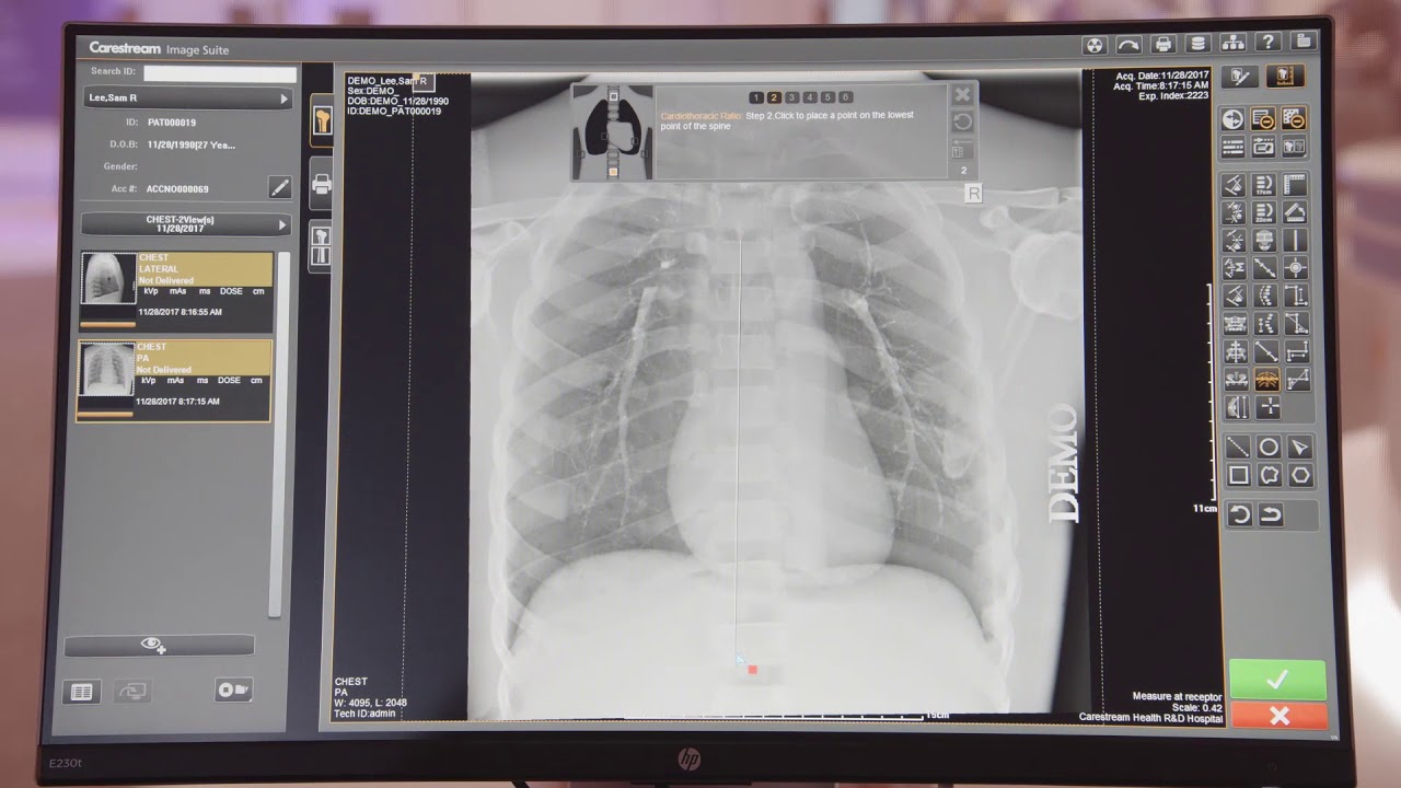 Программное обеспечение CARESTREAM Image Suite с DRX-Detector [рентгеновская визуализация]