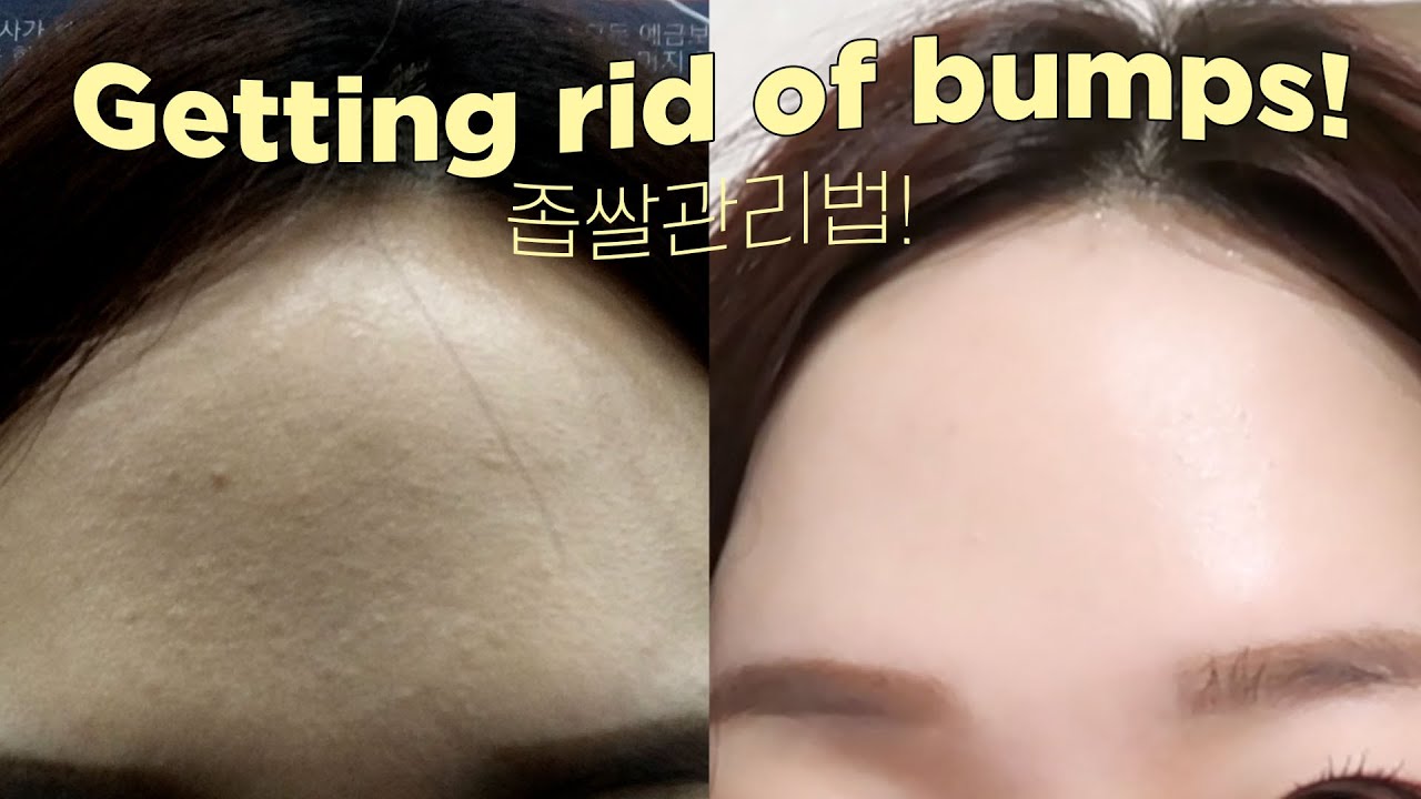 getting rid of bumps/textures on forehead lol