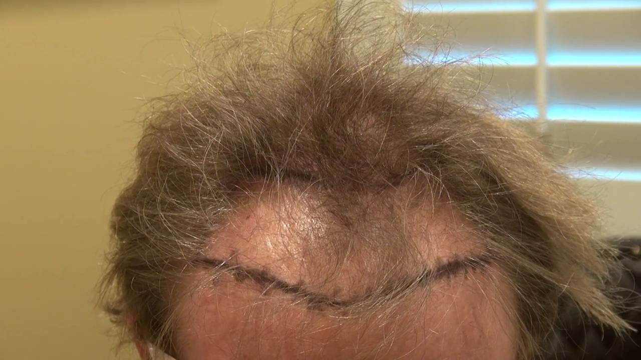 Dr. Diep Hair Transplant Surgery to Correct a Previous Neograft FUE Surgery www.mhtaclinic.com