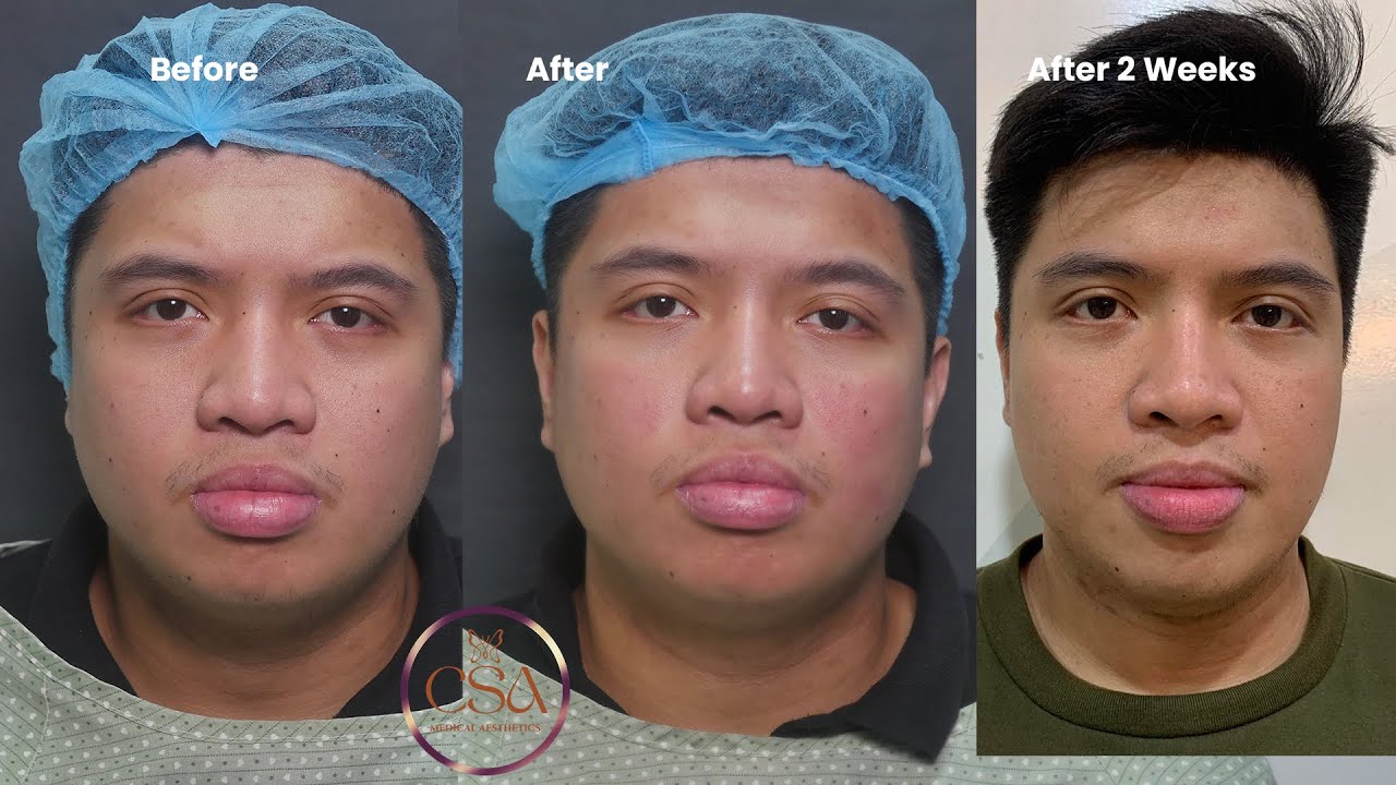 The New Hollywood Spectra  laser for enlarged pores and acne scar treatment