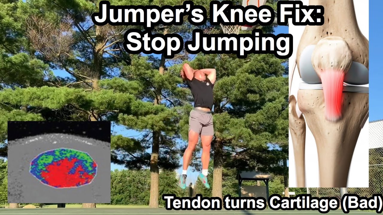 Jumper’s Knee: Stop Jumping Part 1 (Fix Patellar Tendon Pain)