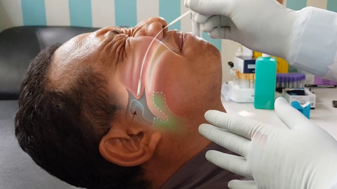 Pelaksanaan Swab Nasofaring