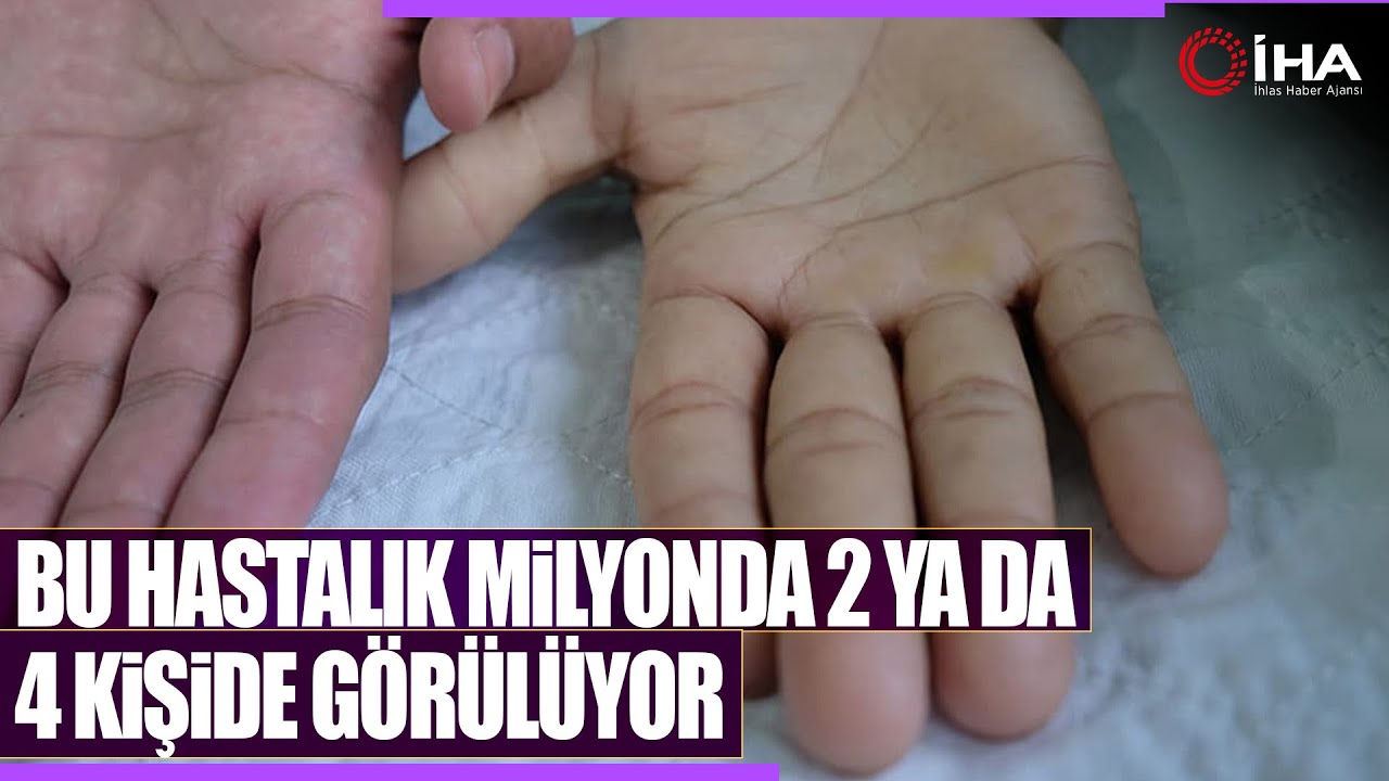 Milyonda 2 Veya 4 Kişide Görülen, Apliastik Anemi Hastalığı Tedavi Edilebiliyor
