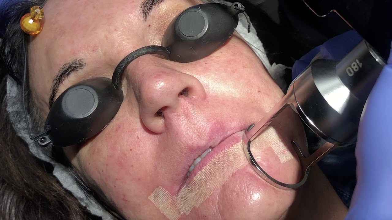 Mixto CO2 Laser | FacesFirst Cosmetic Surgery