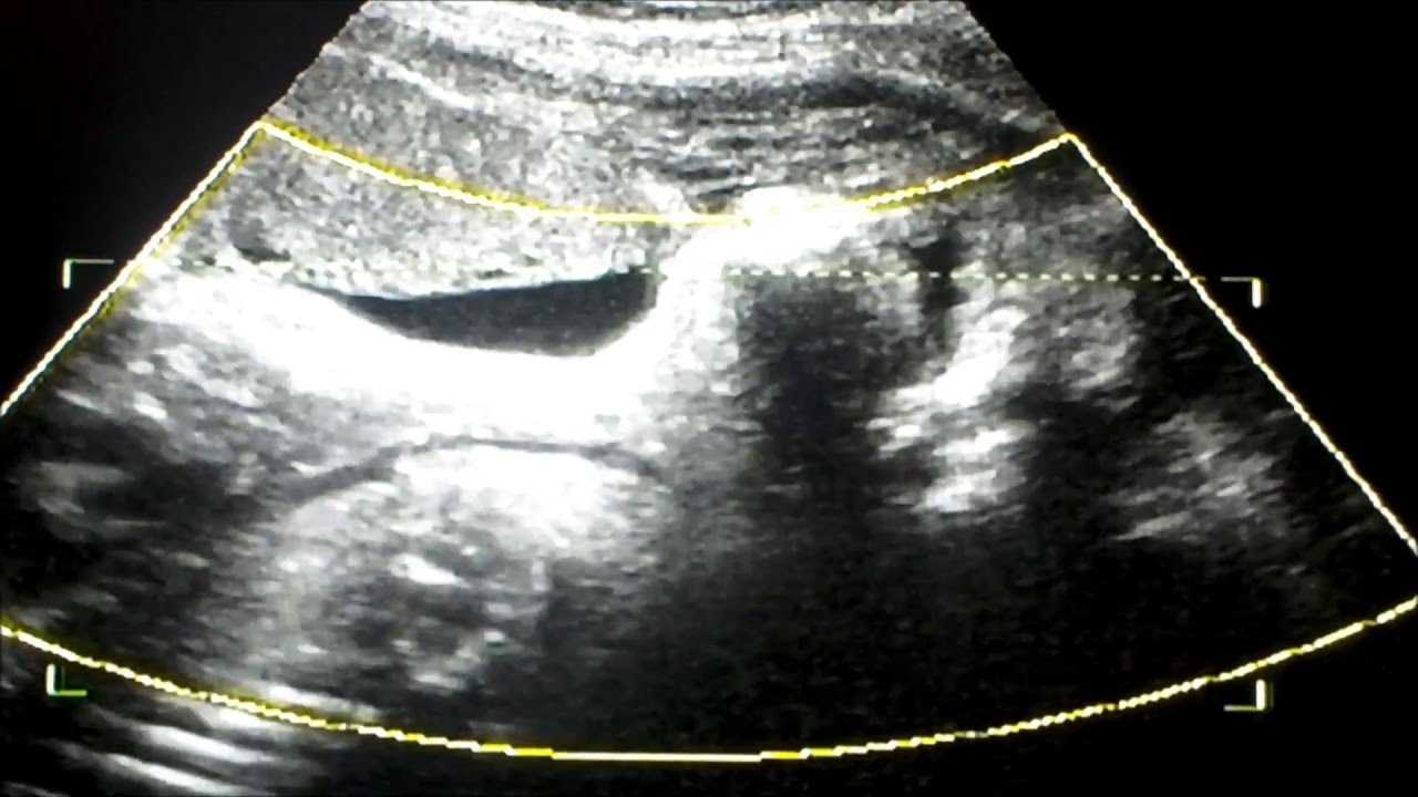 32 week 3d/4d ultrasound