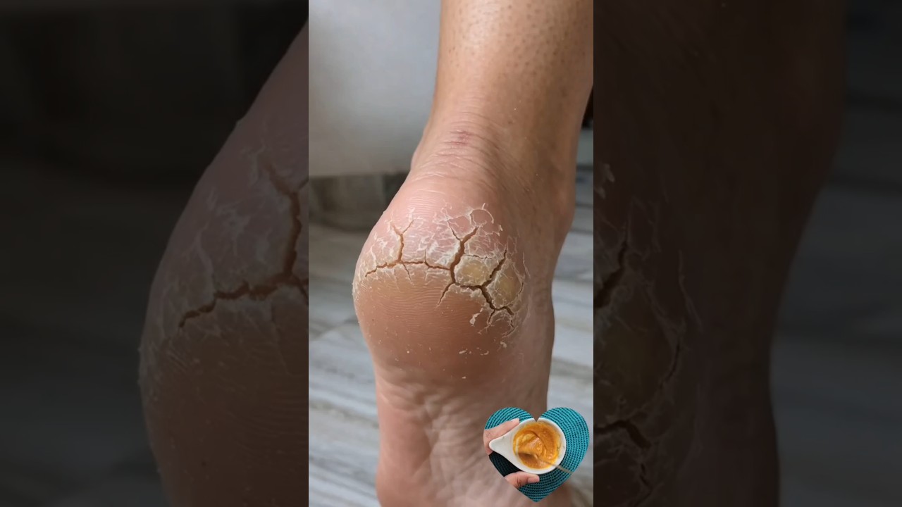 Преображение потрескавшихся пяток 👣 Посмотрите эту простую процедуру по уходу за ногами для чисто...