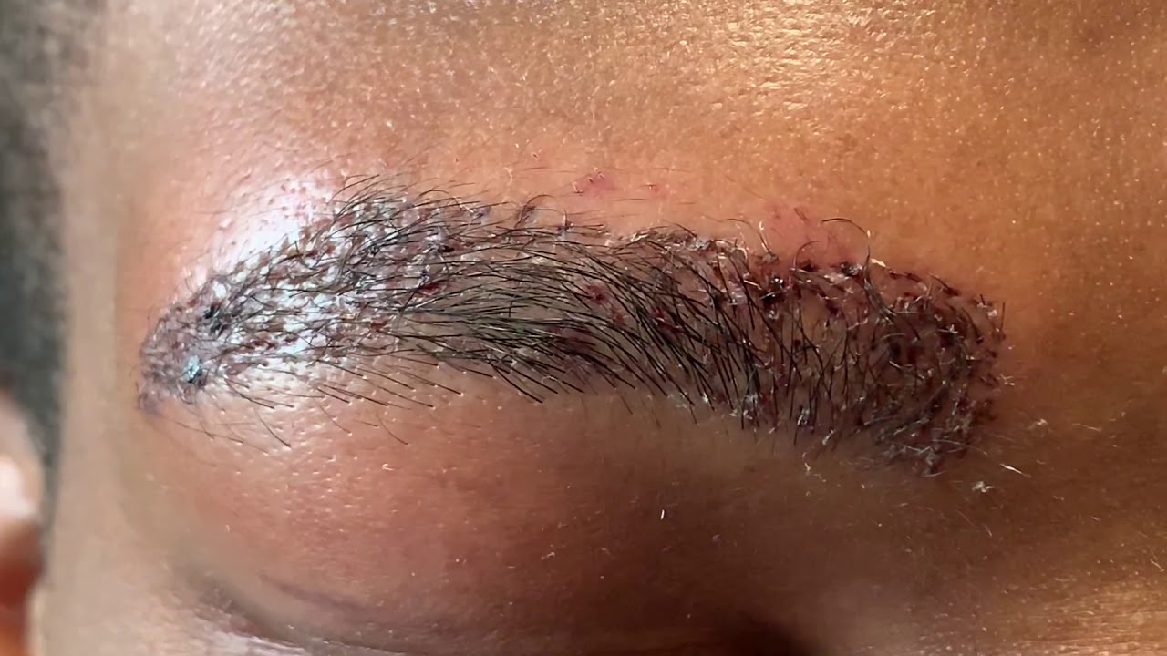 African-American Male Eyebrow Hair Transplant Close-up 1 Day Out