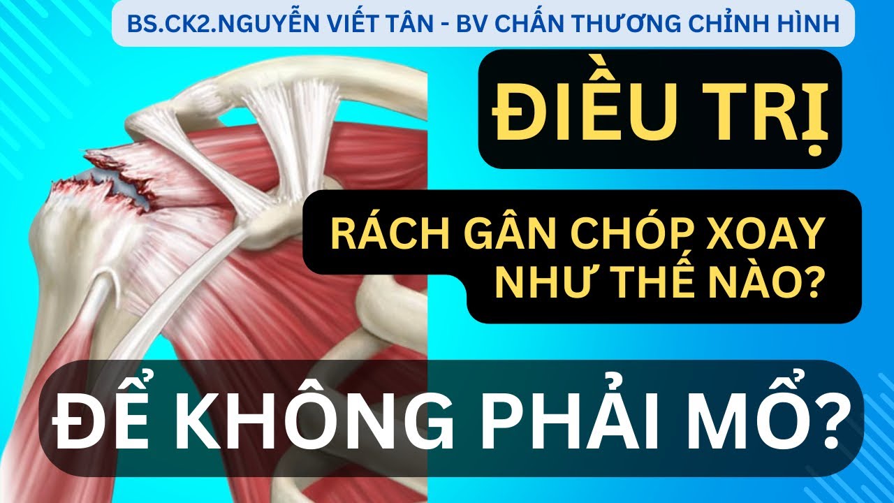 ĐIỀU TRỊ RÁCH GÂN CHÓP XOAY NHƯ THẾ NÀO ĐỂ KHÔNG PHẢI MỔ? - Khớp Việt Official