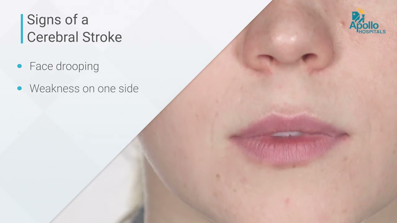 Brain stroke: symptoms, causes and treatment options | Dr. P N Renjen