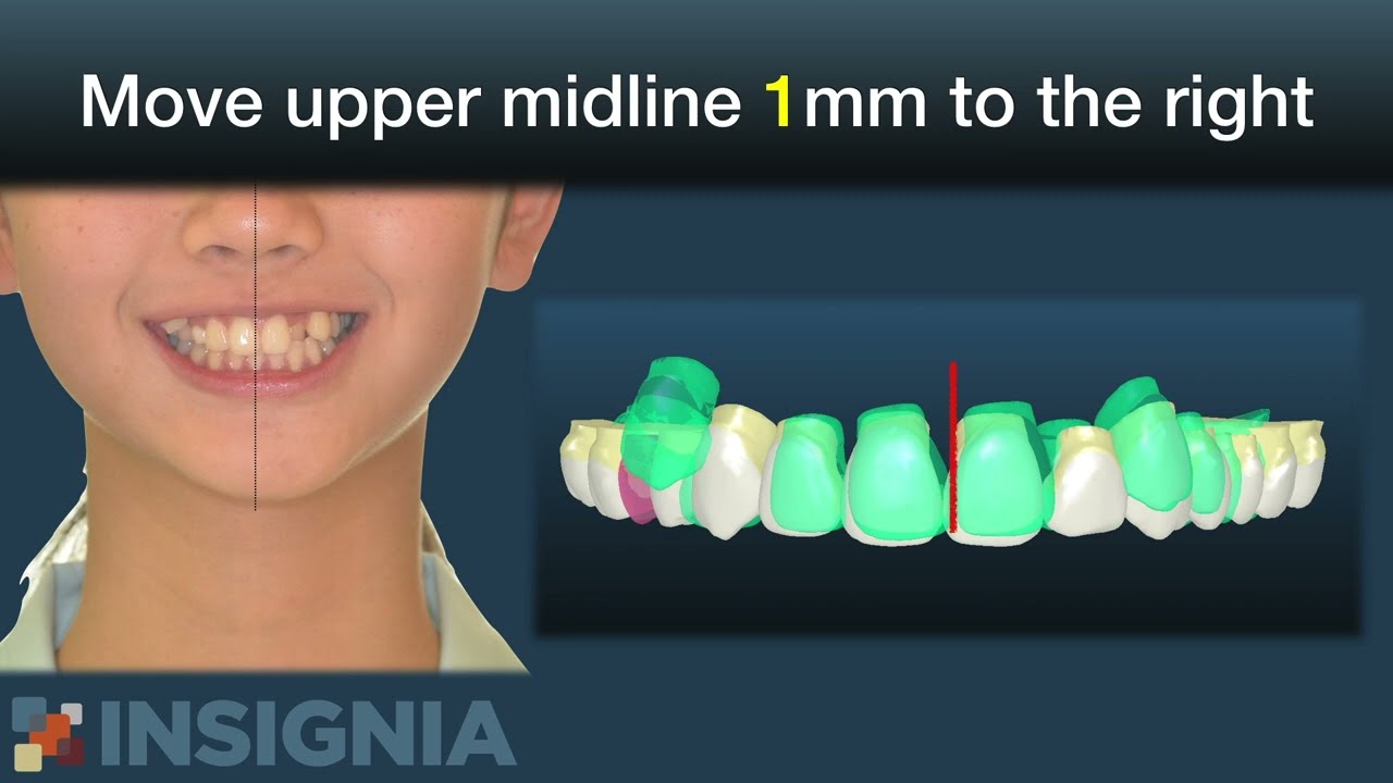 Canine-Bicuspid Tranposition & CII Crowded Malocclusion Treated by Insignia｜【Chris Chang Ortho】CC437