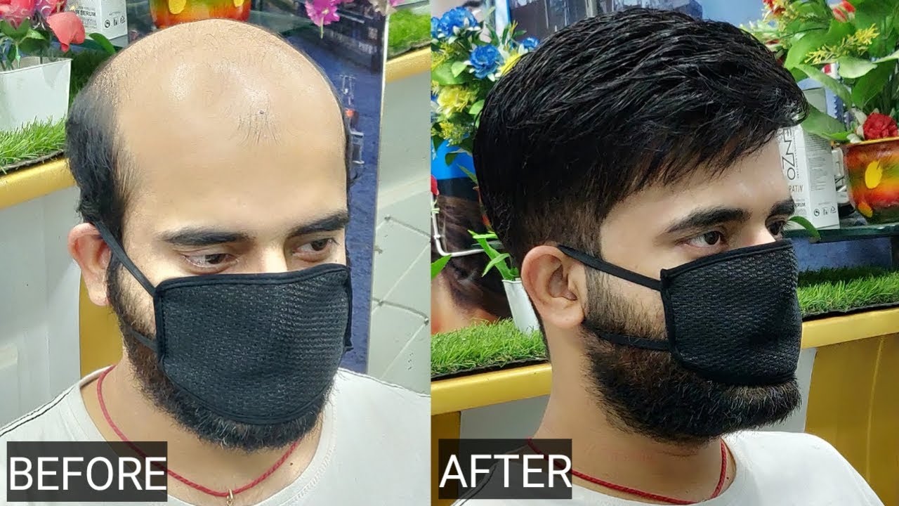 Hair patch, clipping, tapping, bonding, fixing, hair replacement, in Delhi by anas sheikh,9650914665