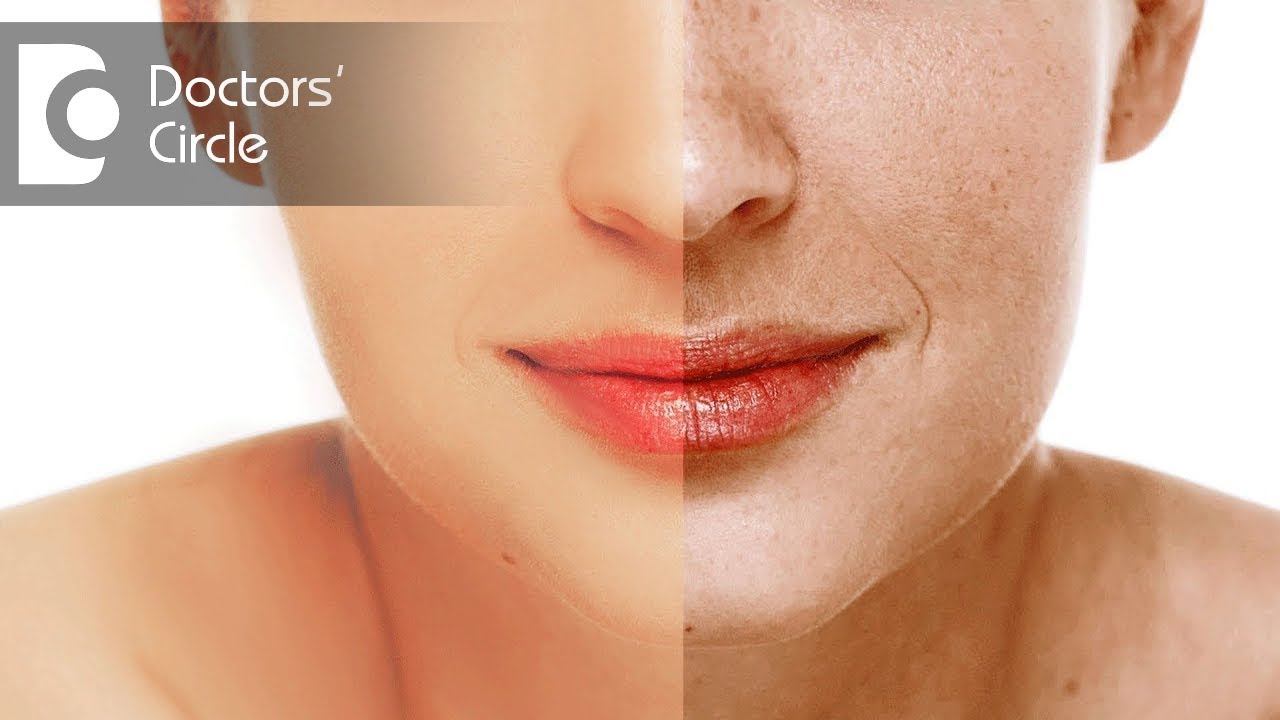 What causes facial hyperpigmentation? - Dr. Priyanka Dasari Reddy