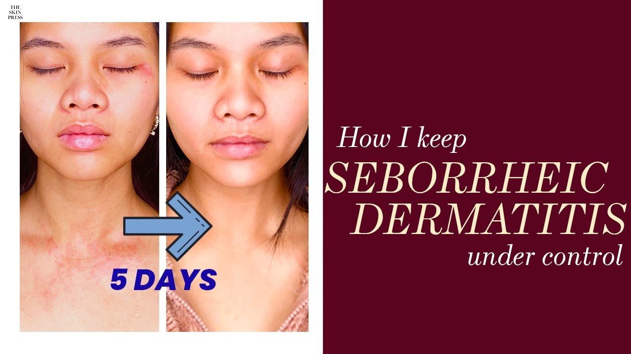 SEBORRHEIC DERMATITIS: My tips on how to prevent relapse | The Skin Press