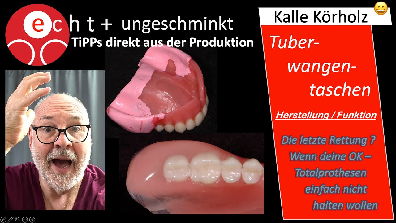 Verbesserter Halt von Totalprothesen - Abformung, Funktion und Unterstützung von Tuberwangentaschen