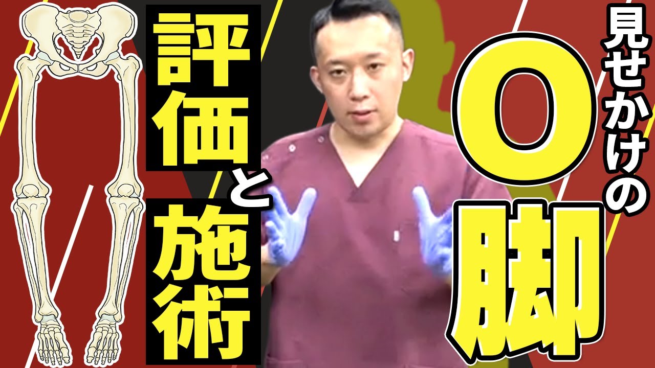 【O脚】膝だけ見るのは無意味。後足部外反を整えるアプローチ