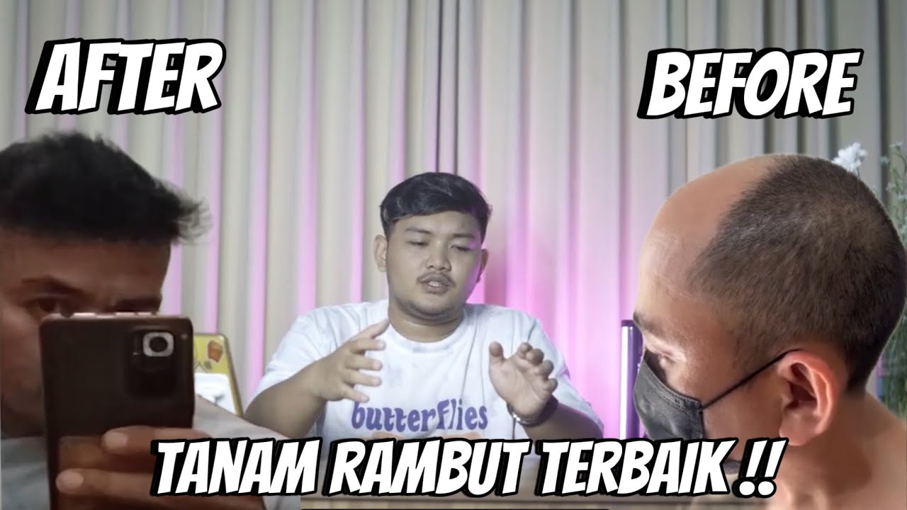 before after tanam rambut terbaik sepanjang masa !!