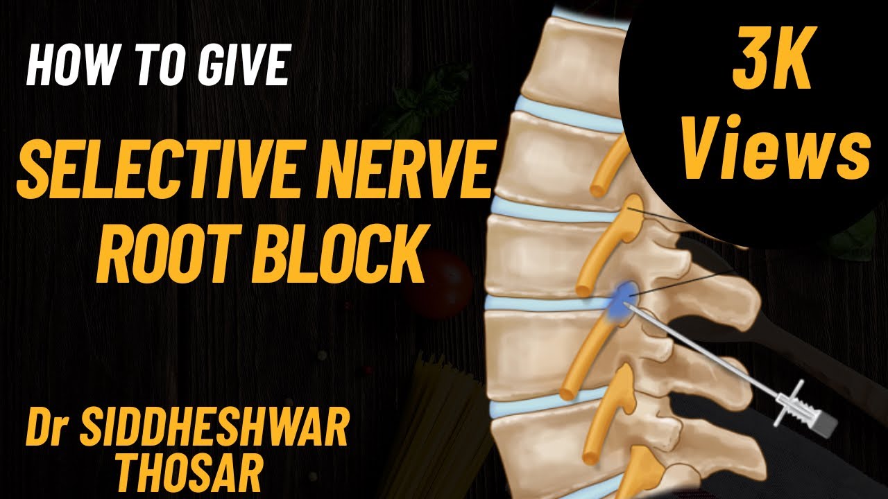 In detail technique of giving selective nerve root block (transforaminal epidural steroid injection)